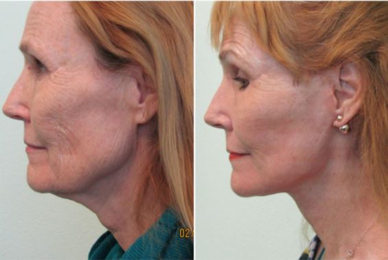 CO2 Laser Resurfacing for Skin, CO2 Laser Treatment in Mexico