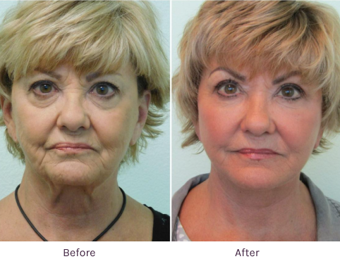 Facial Plastic Surgery Before & After at The Lanfranchi Center Las Vegas