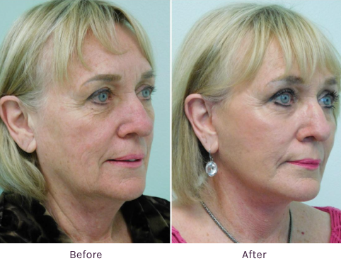 Facial Plastic Surgery Before & After at The Lanfranchi Center Las Vegas
