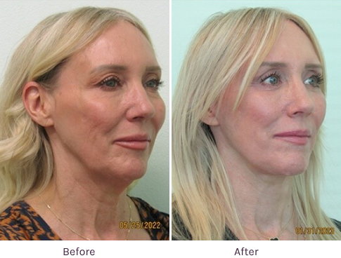 Facial Plastic Surgery Before & After at The Lanfranchi Center Las Vegas