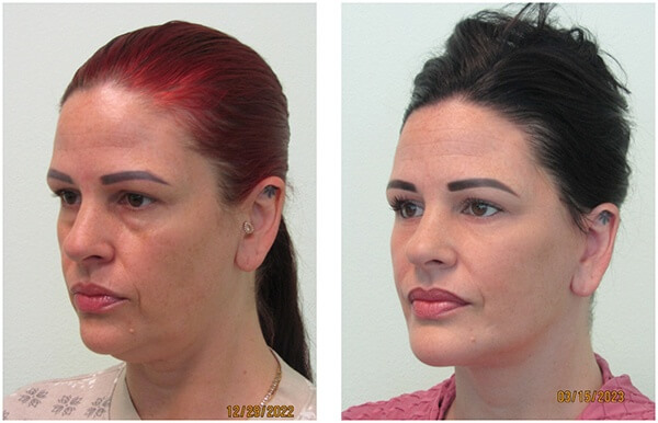 Custom-Facelift-First-Case | The Lafranchi Center