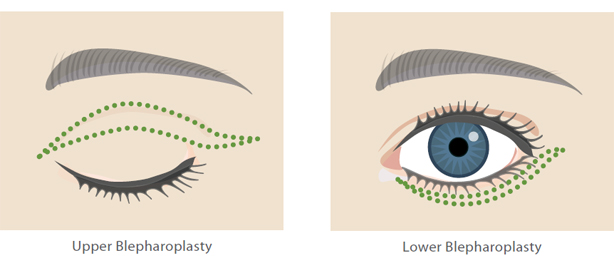 Eyelid-Surgery-Diagram-2 | The Lafranchi Center