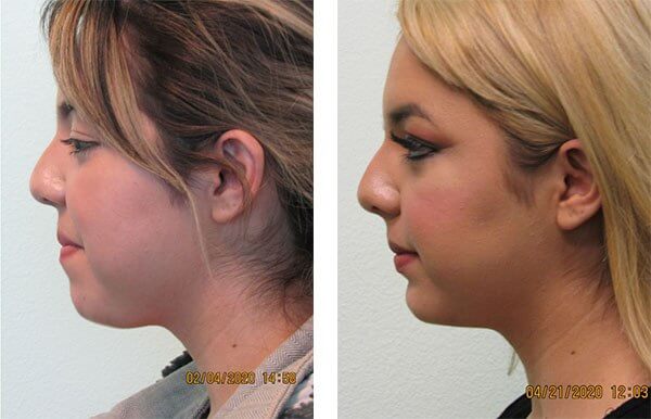 Neck-Liposculpting-First-Case | The Lafranchi Center
