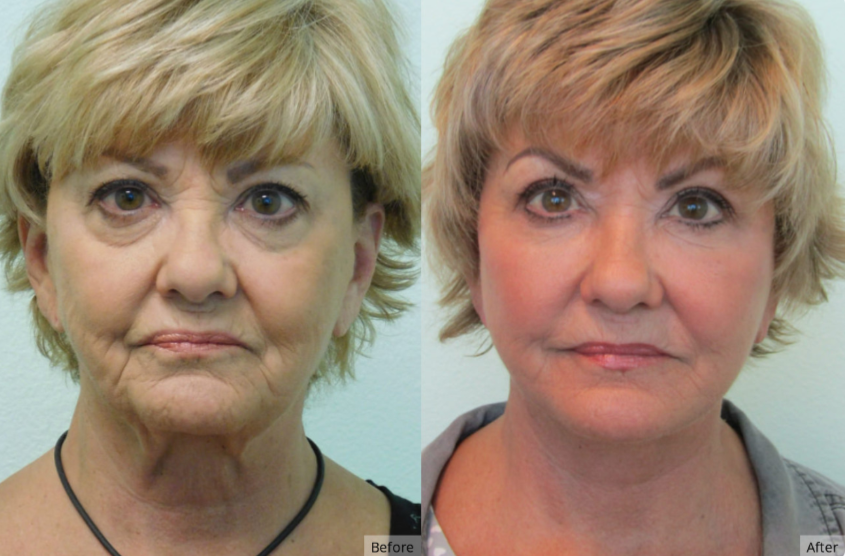 screenshot-thelanfranchicenter_com-2024_12_09-15_40_21 | The Lafranchi Center Facial Fat Transfer, Dermal Fillers Las Vegas & Nevada