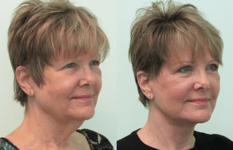 Facelift, TLC Lift, Neck Lift Las Vegas & Nevada | The Lafranchi Center Facelift, TLC Lift, Neck Lift Las Vegas, Nevada