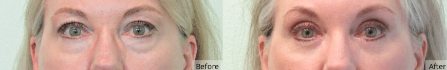 Blepharoplasty Las Vegas & Nevada | The Lafranchi Center Blepharoplasty Las Vegas & Nevada