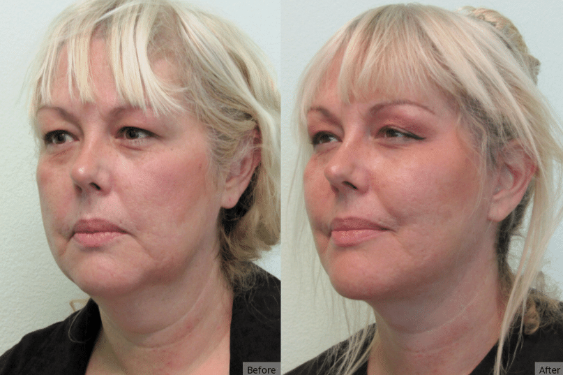 Facelift, Las Vegas & Nevada