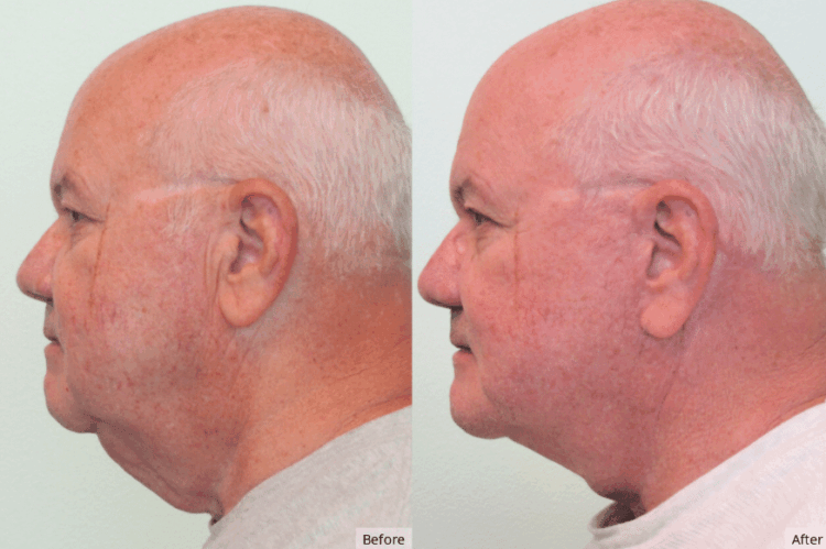 Facelift, Las Vegas & Nevada | The Lafranchi Center Facelift, Las Vegas & Nevada