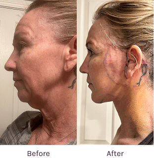 Facelift Testimonial Image | The Lafranchi Center