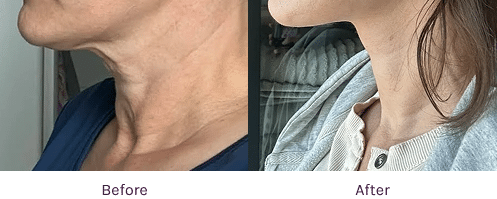 Necklift Testimonial | The Lafranchi Center