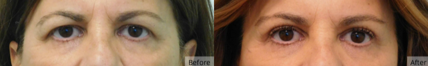 Brow Lift, Las Vegas & Nevada | The Lafranchi Center Brow Lift, Las Vegas & Nevada