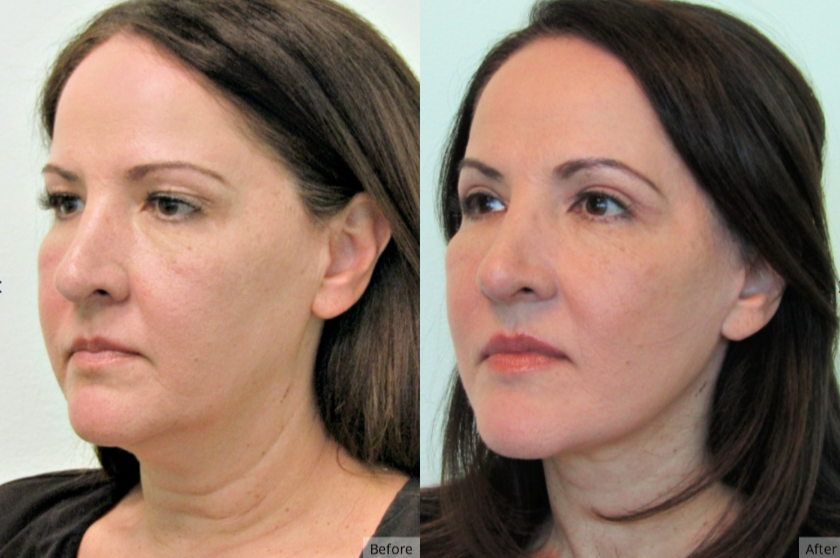 Facelift, Las Vegas & NevadaFacelift, Las Vegas & Nevada | The Lafranchi Center Facelift, Las Vegas & Nevada