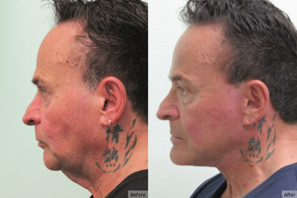 Facelift, Las Vegas & Nevada | The Lafranchi Center Facelift, Las Vegas & Nevada