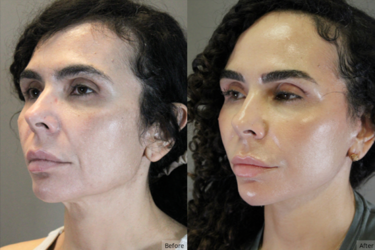 Facelift, Chin Augumentation, Las Vegas & Nevada | The Lafranchi Center Facelift, Chin Augumentation, Las Vegas & Nevada