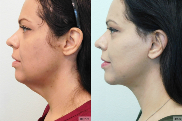 Mini Facelift, Las Vegas & Nevada