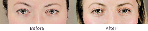 Side-by-side before and after photos showing improved facial skin around the eyes after treatment (Left: Before, Right: After).