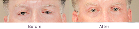 Close-up of a man's face split into two halves labeled Before and After, showing skincare improvement.